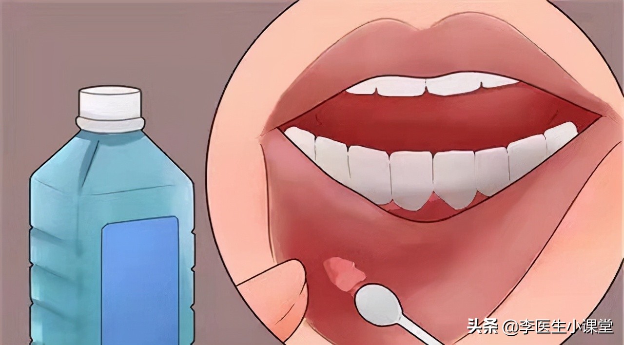 过氧化氢溶液可以漱口吗（为什么双氧水漱口后牙龈更痛）