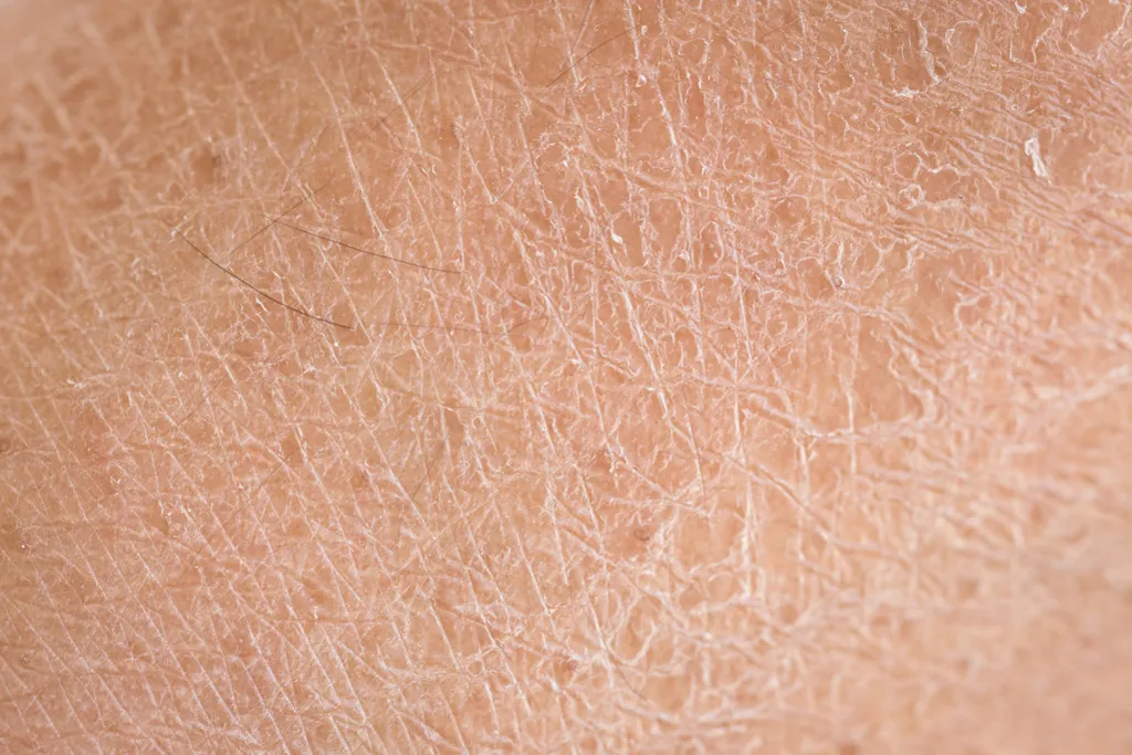尿素霜的功效可以去鸡皮吗（长期涂尿素霜的人皮肤怎么样）