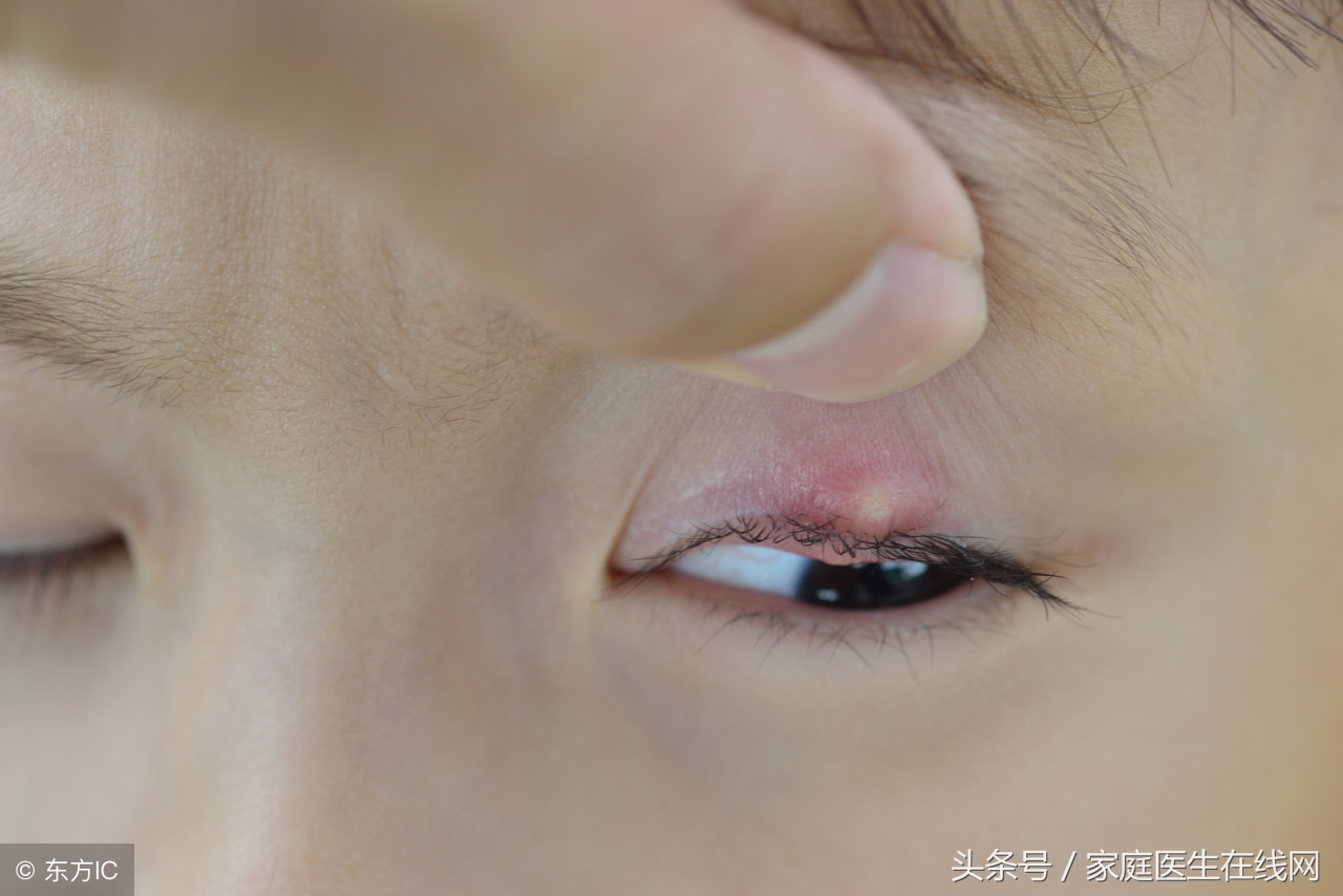 儿童眼睛麦粒肿的特写。高清摄影大图-千库网